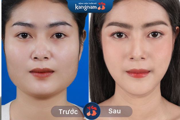 Ca gọt hàm đẹp tự nhiên, đẹp xuất sắc