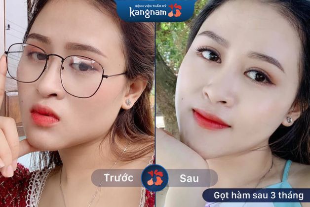 Hình ảnh khách hàng sau 3 tháng thực hiện gọt hàm