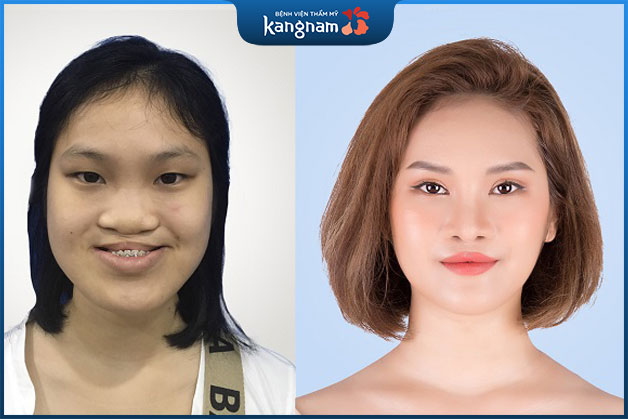 Cao Thị Lan hô nặng sau khi cắt hàm hô: xương hàm cân đối, mặt thon gọn (*)