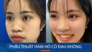 Giảm đau nhanh chóng sau phẫu thuật hàm hô – Tận hưởng quá trình hồi phục nhẹ nhàng