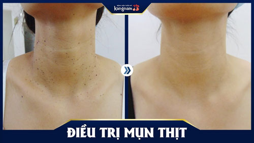 trị mụn thịt
