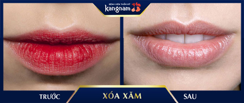 xóa xăm kangnam cách làm mờ vết xăm môi