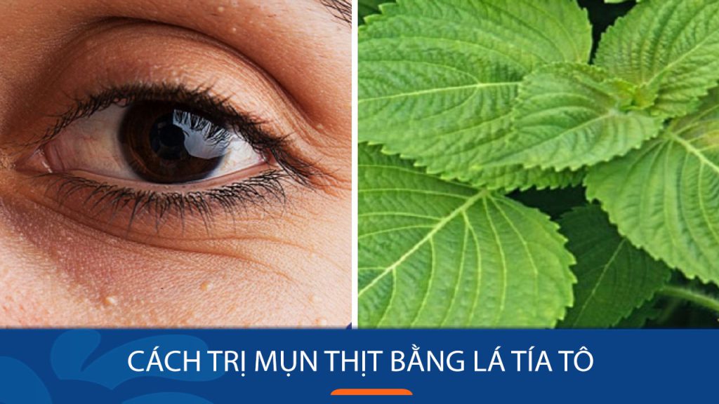 Cách trị mụn thịt tận gốc bằng lá tía tô đơn giản tại nhà