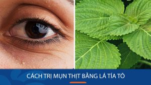 Cách trị mụn thịt tận gốc bằng lá tía tô đơn giản tại nhà