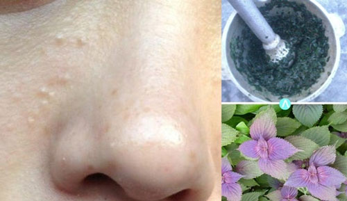 Dùng lá tía tô nguyên chất trị mụn thịt rất hiệu quả trị mụn thịt bằng lá tía tô