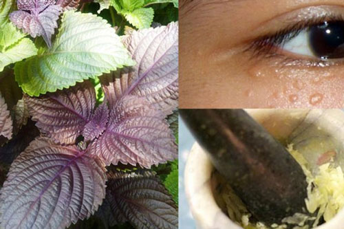 Trị mụn thịt ở mắt bằng lá tía tô và tỏi giúp phát huy hiệu quả tối ưu hơn Trị mụn thịt ở mắt bằng lá tía tô và tỏi