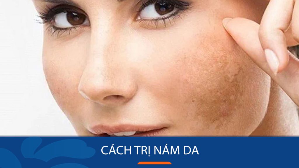 12+ Cách trị nám da lâu năm An Toàn, Nhanh Chóng