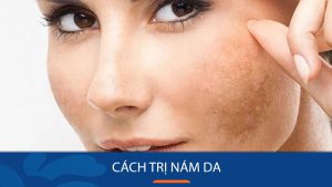 12+ Cách trị nám da lâu năm An Toàn, Nhanh Chóng