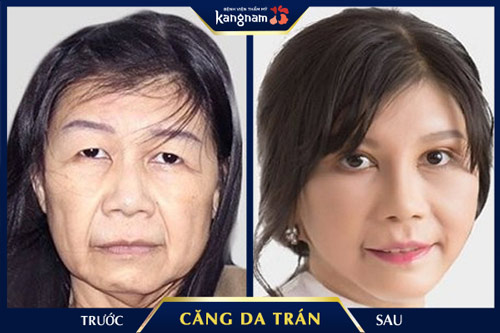 Màn lột xác ngoạn mục của thí sinh Hành Trình Lột Xác 2018, trẻ ra đến hàng chục tuổi sau căng da trẻ hóa căng da trán kangnam