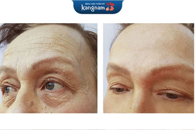 Căng da trán nội soi