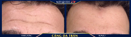 Vùng trán có nếp nhăn sâu đã được khắc phục hoàn toàn sau khi thực hiện dịch vụ căng da trẻ hóa tại BVTM Kangnam căng da trán nội soi