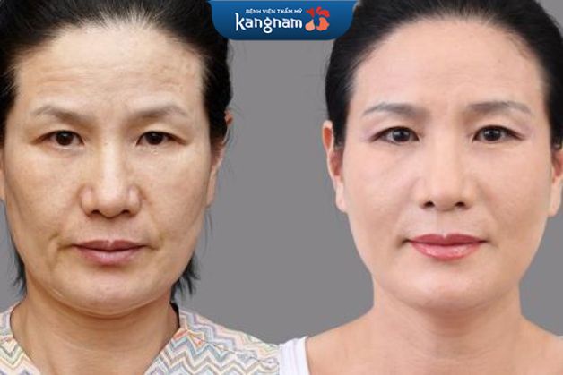 Căng da trán hiệu quả nhanh chóng không để lại sẹo