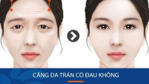 Căng Da Trán Có Đau Không? Chi Phí Bao Nhiêu Tại Kangnam?