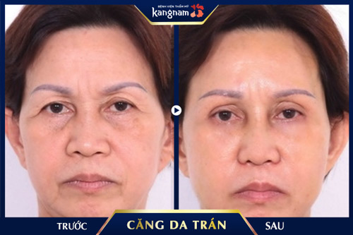 Vùng da trán chảy xệ, chùng nhão đã được kéo căng trở nên phẳng nhẵn, đầy đặn làm bừng sáng gương mặt hơn căng da vùng trán