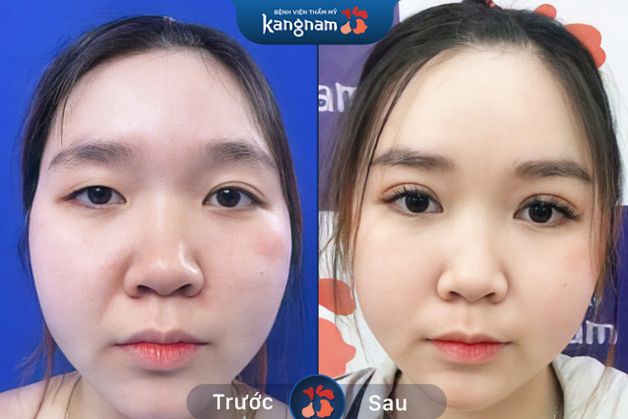 Khách hàng cắt mí Perfect Eyes không đau, hồi phục nhanh