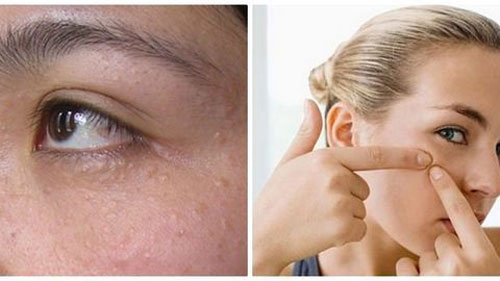 Khi trị mụn thịt bằng tía tô không nên tự ý dùng tay nặn mụn Trị mụn thịt bằng lá tía tô