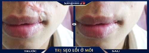 Chuyên khoa trị sẹo Kangnam khắc phục toàn bộ vùng sẹo môi có kích thước lớn, co kéo nhiều Chuyên khoa trị sẹo Kangnam khắc phục toàn bộ vùng sẹo môi có kích thước lớn, co kéo nhiều