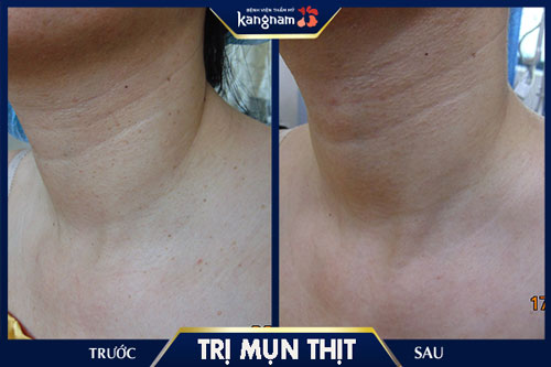 Cận cảnh kết quả khách hàng sau khi trị mụn thịt tại Kangnam Điều trị mụn thịt ở cổ