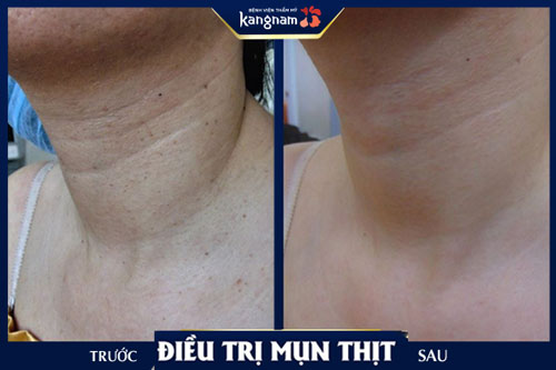 Hình ảnh khách hàng trị mụn thịt ở cổ tại Kangnam trị mụn thịt ở cổ tại Kangnam