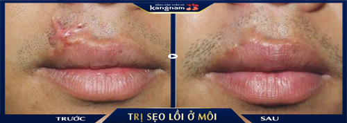 Xóa bỏ hoàn toàn vết sẹo thứ phát ở môi, trả về vẻ thẩm mỹ, sự tự tin cho khách hàng Xóa bỏ hoàn toàn vết sẹo thứ phát ở môi, trả về vẻ thẩm mỹ, sự tự tin cho khách hàng