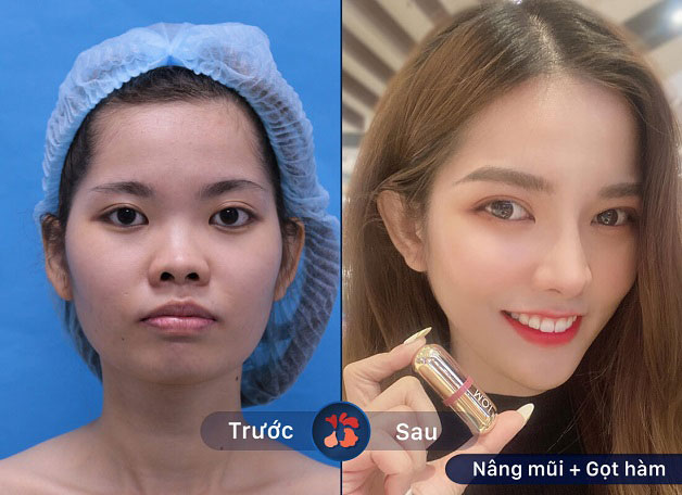 Gọt hàm có nguy hiểm không?