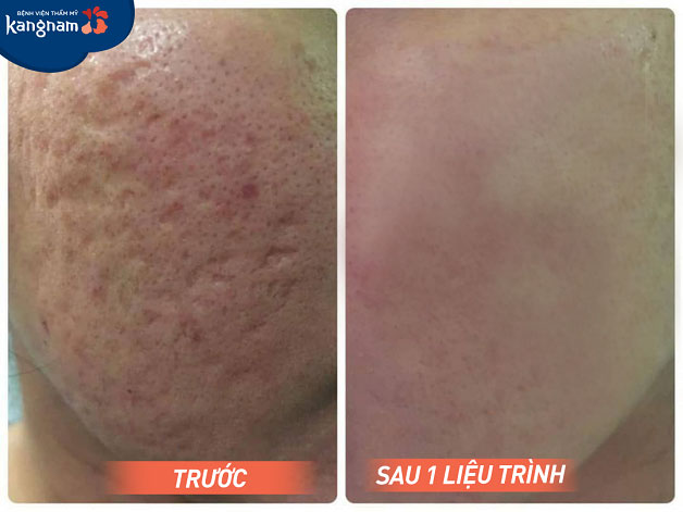 Gương mặt nhiều vết sẹo lõm, rỗ li ti đã hoàn toàn được thay đổi bằng làn da sáng mịn, tươi tr