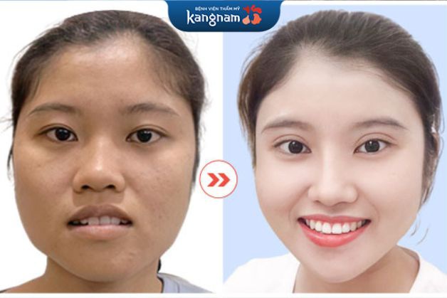 Hình ảnh kết quả trước và sau khi thực hiện Thu gọn góc hàm V line 3D