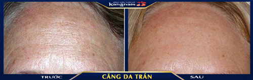 Toàn bộ vùng da trán lão hóa đều được khắc phục hoàn toàn, không để lộ dấu vết thẩm mỹ làm căng da trán