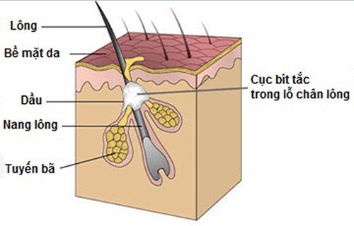 mụn thịt ở ngực