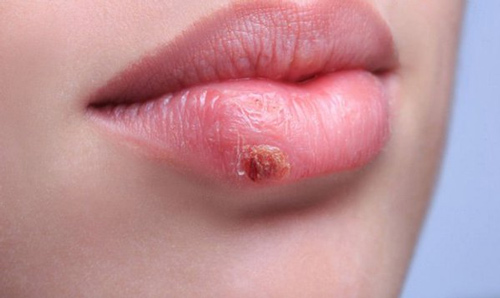 Môi có vết thương hở, mụn rộp là nguyên nhân chính hình thành sẹo Môi có vết thương hở, mụn rộp là nguyên nhân chính hình thành sẹo