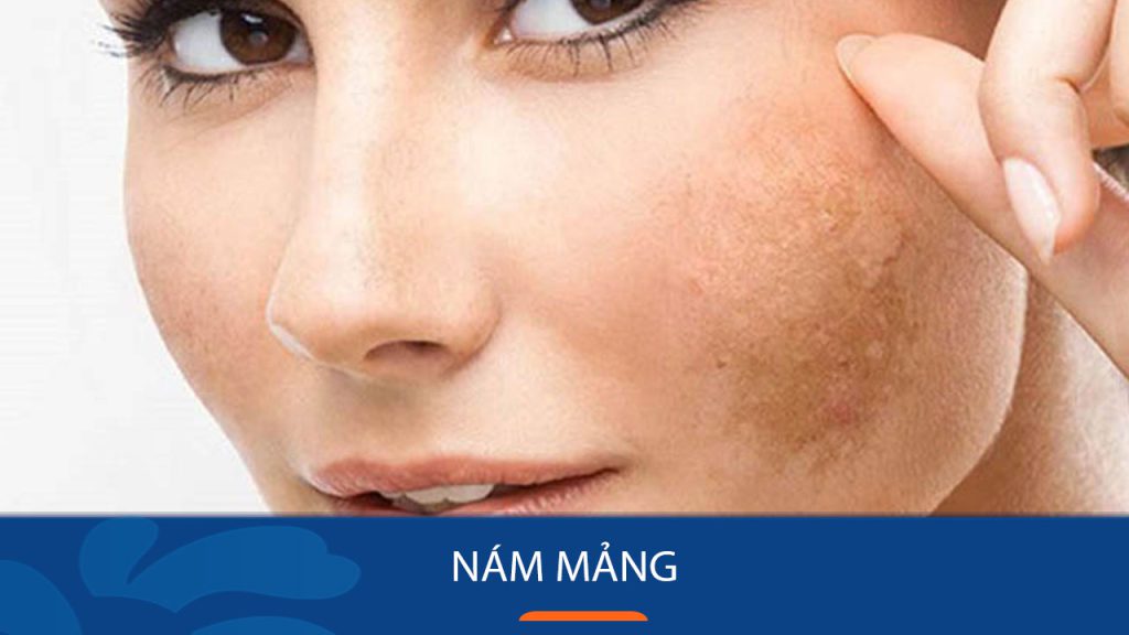 Nám mảng là gì? Nguyên nhân và cách chữa nám mảng