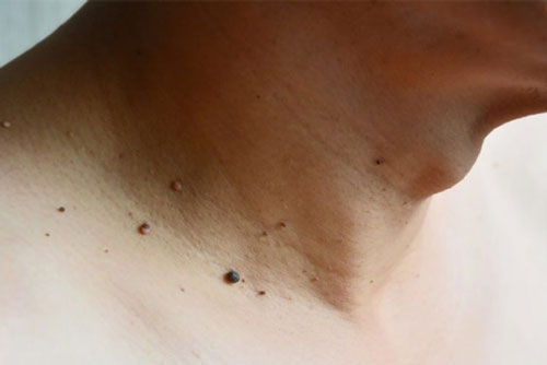 Mụn thịt ở cổ mặc dù không nguy hiểm tới sức khỏe nhưng lại gây mất thẩm mỹ mụn thịt ở cổ có nguy hiểm không