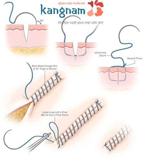 Tùy từng trường hợp sẹo thực tế, bác sĩ sẽ áp dụng kĩ thuật khâu khác nhau để đảm bảo kết quả thẩm mỹ cao nhất Tùy từng trường hợp sẹo thực tế, bác sĩ sẽ áp dụng kĩ thuật khâu khác nhau để đảm bảo kết quả thẩm mỹ cao nhất