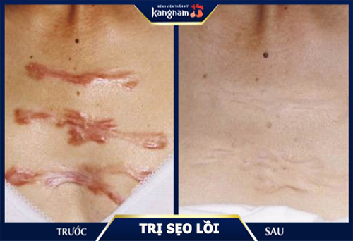 là sẹo lồi ở đâu