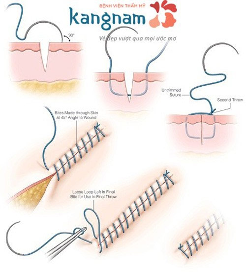 Đối với những vết sẹo nhỏ, kĩ thuật khâu thẩm mỹ được áp dụng để khắc phục toàn bộ vùng sẹo tận gốc phẫu thuật trị sẹo