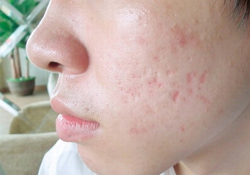 Sẹo lõm sau thủy đậu là tình trạng phổ biến ở hơn 80% người mắc bệnh Sẹo thủy đậu bao lâu thì hết