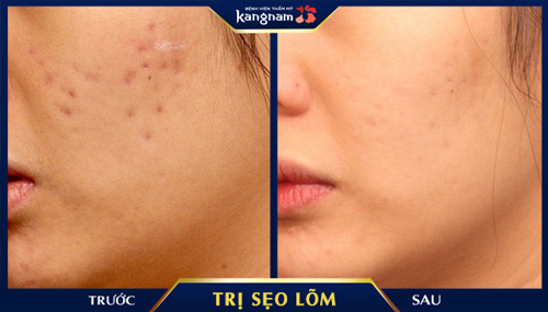 Sẹo lõm, sẹo rỗ lâu năm do thủy đậu được khắc phục hoàn toàn, trả về làn da đều màu, sáng mịn Kết quả khách hàng sau khi điều trị sẹo tại Kangnam