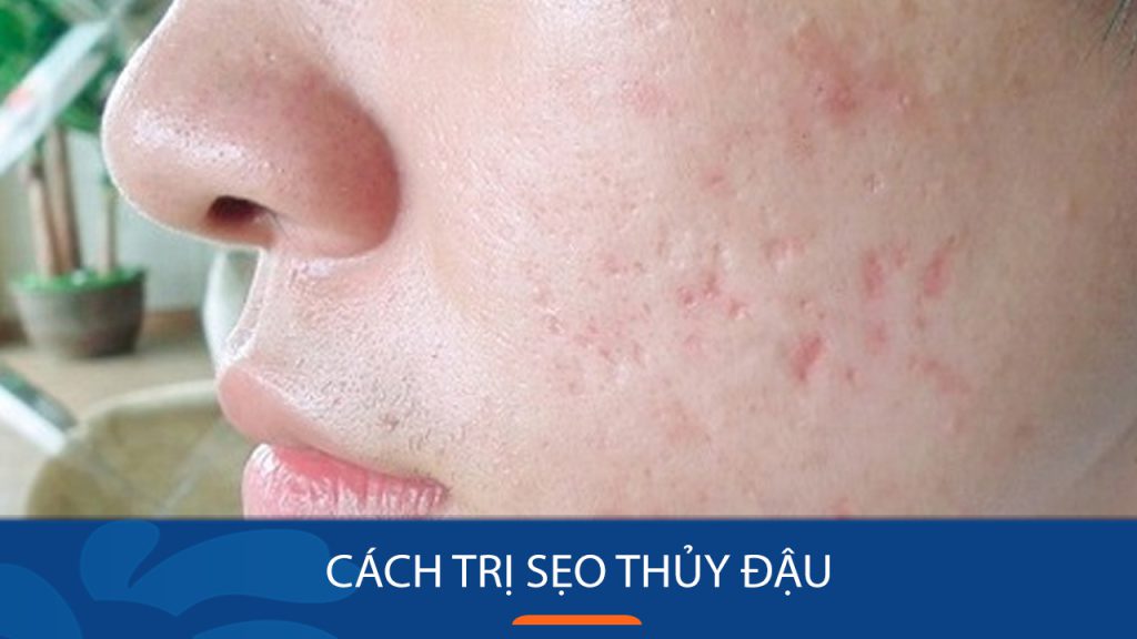 6 Cách Trị Sẹo Thủy Đậu Hiệu Quả Tại Nhà – Nhanh Chóng – An Toàn