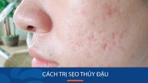 6 Cách Trị Sẹo Thủy Đậu Hiệu Quả Tại Nhà – Nhanh Chóng – An Toàn