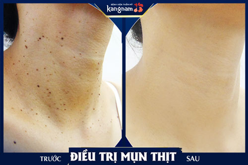 Hình ảnh khách hàng trị mụn thịt ở cổ tại Kangnam trị mụn thịt ở cổ tại Kangnam