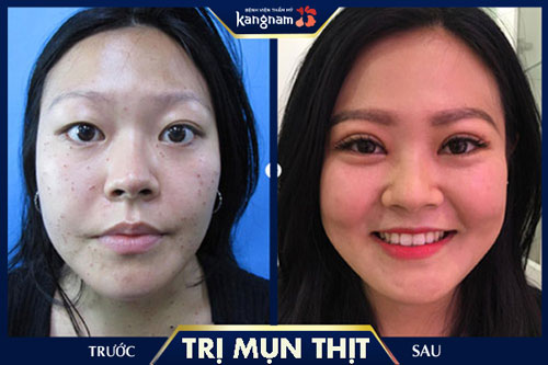 Mụn thịt ở mũi, má được xóa bỏ, da láng mịn không để lại sẹo cách trị mụn thịt ở mũi