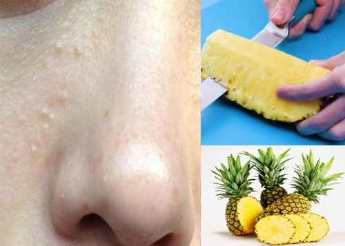 Trị mụn thịt ở mũi với dứa được nhiều người áp dụng thành công trị mụn thịt ở mũi