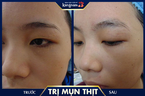 điều trị mụn thịt