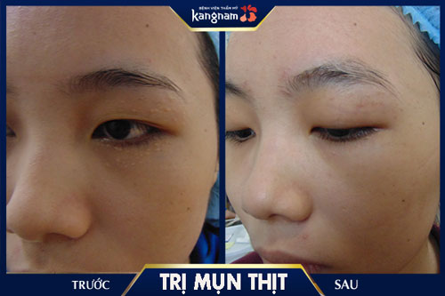 Kết quả khách hàng sau khi trị mụn thịt tại Kangnam trị mụn thịt tại Kangnam