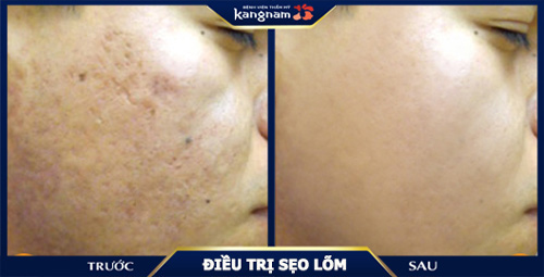 Kết quả thay đổi đáng kinh ngạc của khách hàng sau khi xóa sẹo lõm, rỗ bằng công nghệ Scar Nano