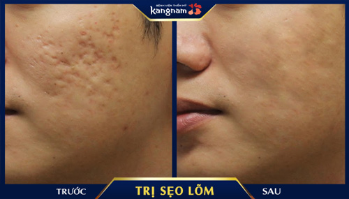 90% các vết sẹo lõm sâu đều được làm đầy, trả về làm da nhẵn mịn cho khách hàng 90% các vết sẹo lõm sâu đều được làm đầy, trả về làm da nhẵn mịn cho khách hàng