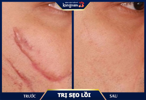 xóa sẹo lồi ở đâu tốt nhất 