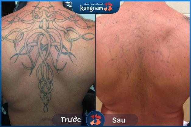 Hình xăm sau 1 lần điều trị đầu tiên