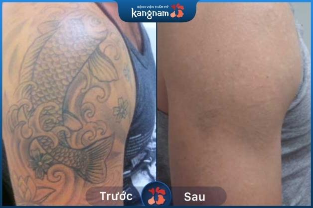 Hình xăm màu đậm bay đáng kể sau 2 lần xóa xăm