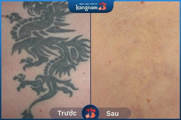 Hình xăm gần như biến mất hoàn toàn – da đều màu sau 4 lần xóa xăm